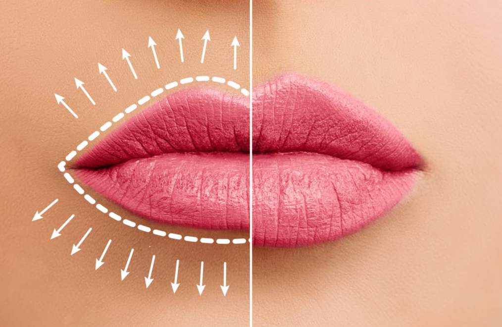 How Do I Find the Best Price for Juvederm